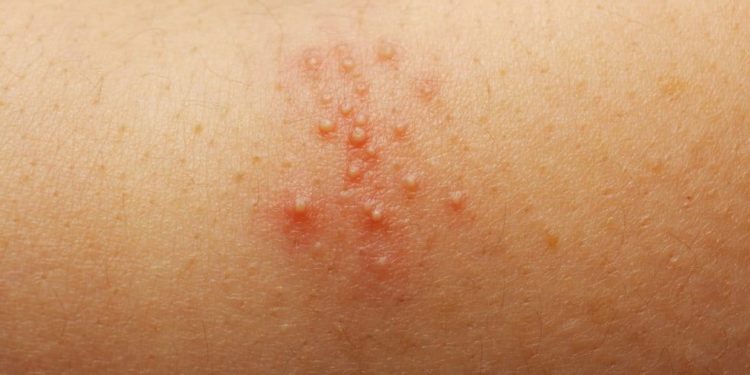 Hitzepickel im Sommer: Was hilft?  No.1 Cosmetics