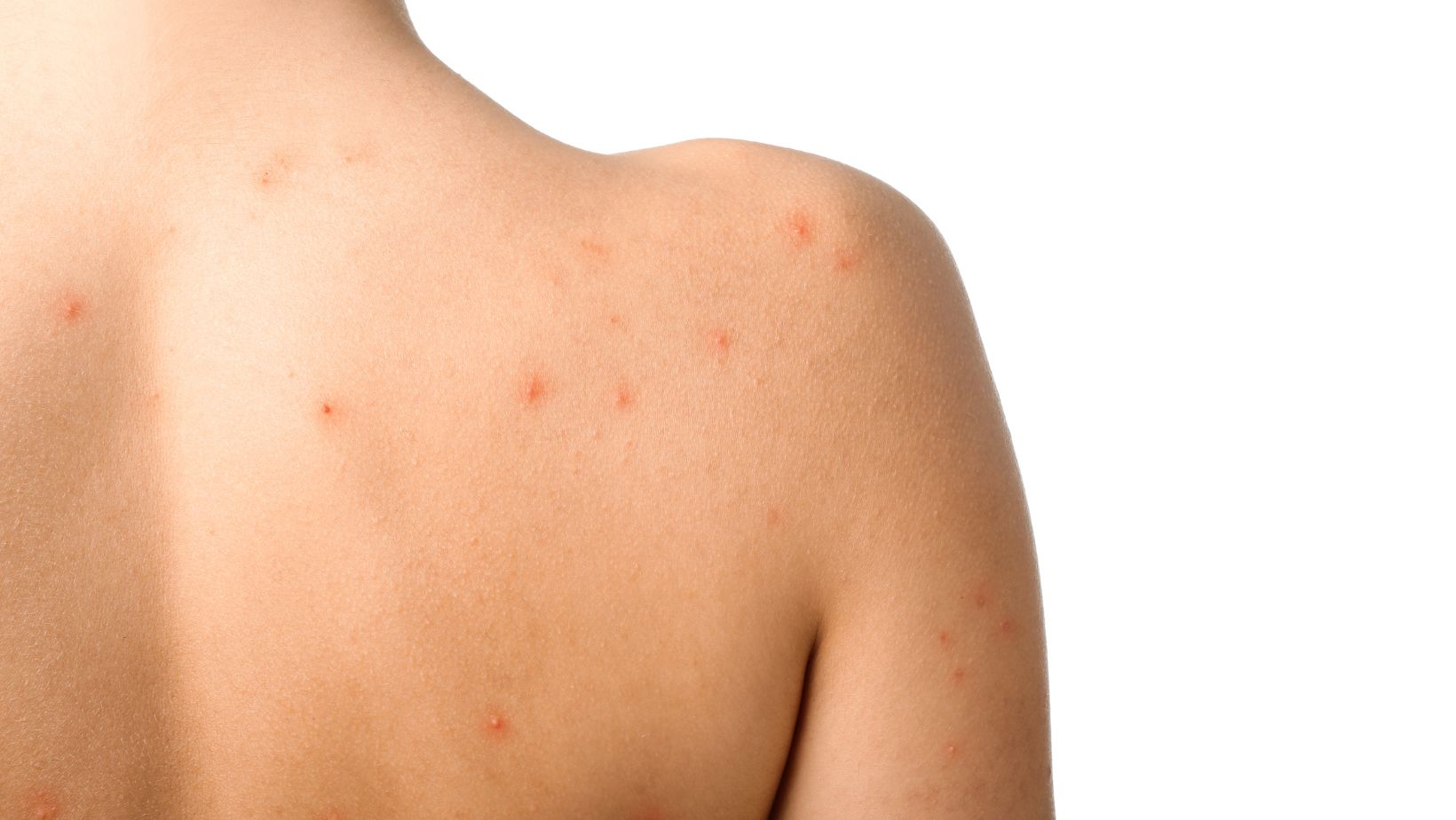 Pickel am Rücken? Unsere Tipps gegen Bacne