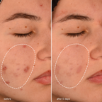 dermalogica - Breakout Biotic Moisturizer