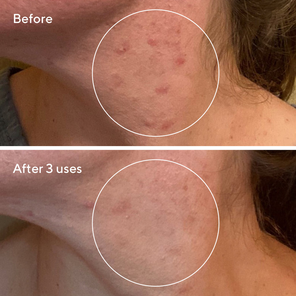 Murad BLEMISH CONTROL - RAPID RELIEF SULFUR MASK