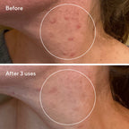 Murad BLEMISH CONTROL - RAPID RELIEF SULFUR MASK