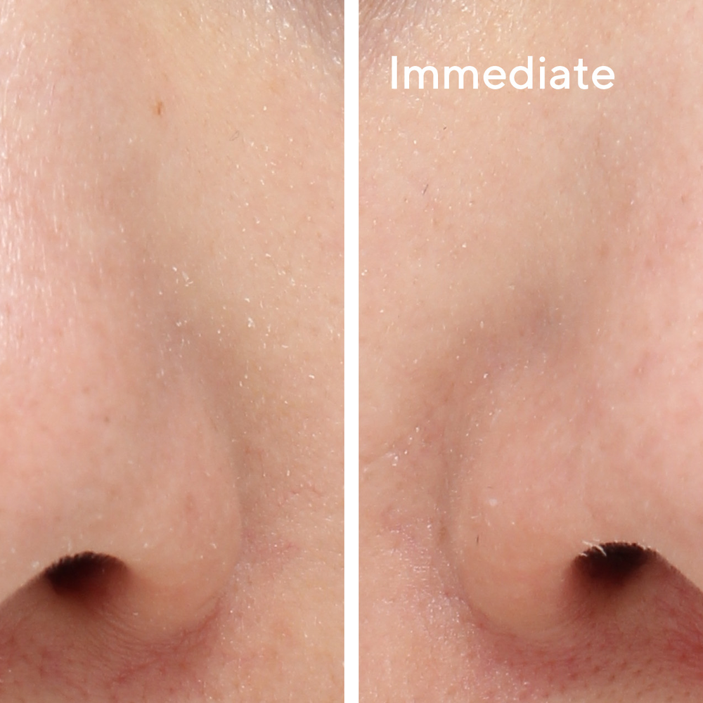 Murad BLEMISH CONTROL - TARGETED PORE CORRECTOR