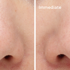 Murad BLEMISH CONTROL - TARGETED PORE CORRECTOR