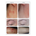Vorher-Nachher-Vergleich der Haut, der nach der Anwendung von ESSE Skincare Barrier Rescue eine Verringerung von Rötungen, Schuppenbildung und Reizungen im Hals-, Augenlid- und Armbereich zeigt.