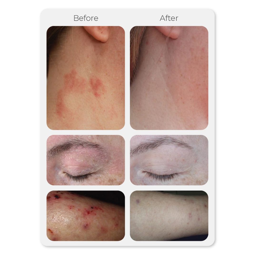 Vorher-Nachher-Vergleich der Haut, der nach der Anwendung von ESSE Skincare Barrier Rescue eine Verringerung von Rötungen, Schuppenbildung und Reizungen im Hals-, Augenlid- und Armbereich zeigt.