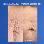 VOL.U.LIFT BODY Vorher nachher Bauch nach 3 Wochen