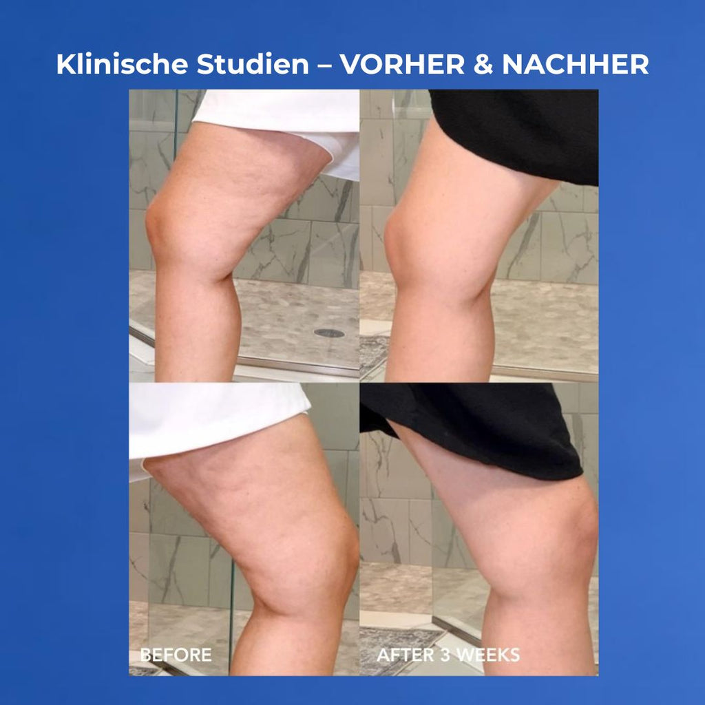 VOL.U.LIFT BODY Vorher nachher Cellulite nach 3 Wochen