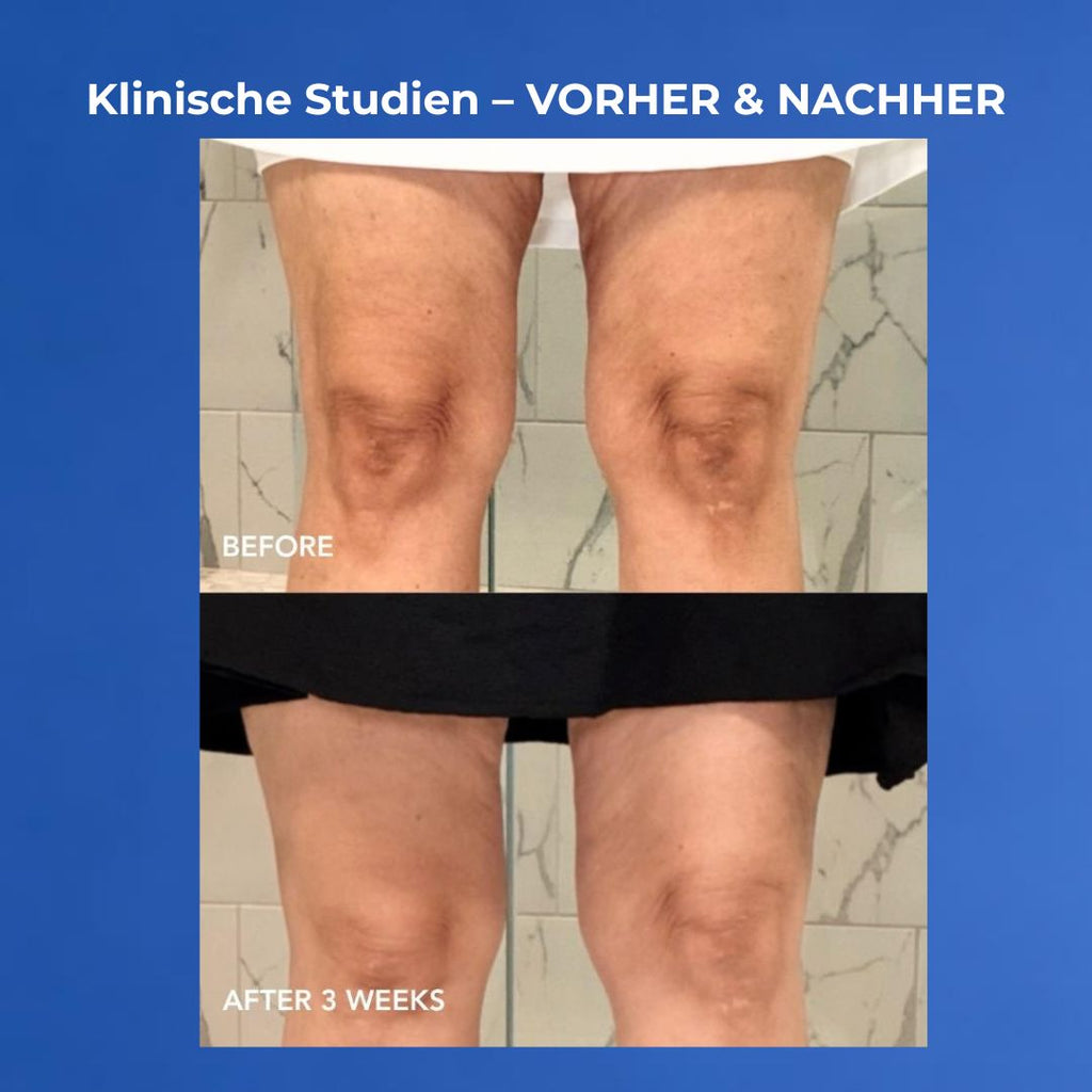 VOL.U.LIFT BODY Vorher nachher Knie nach 3 Wochen