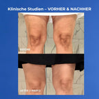 VOL.U.LIFT BODY Vorher nachher Knie nach 3 Wochen
