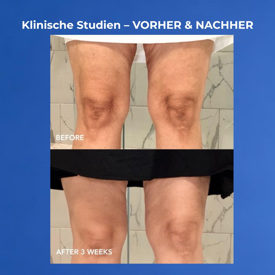 VOL.U.LIFT BODY Vorher nachher Knie nach 3 Wochen