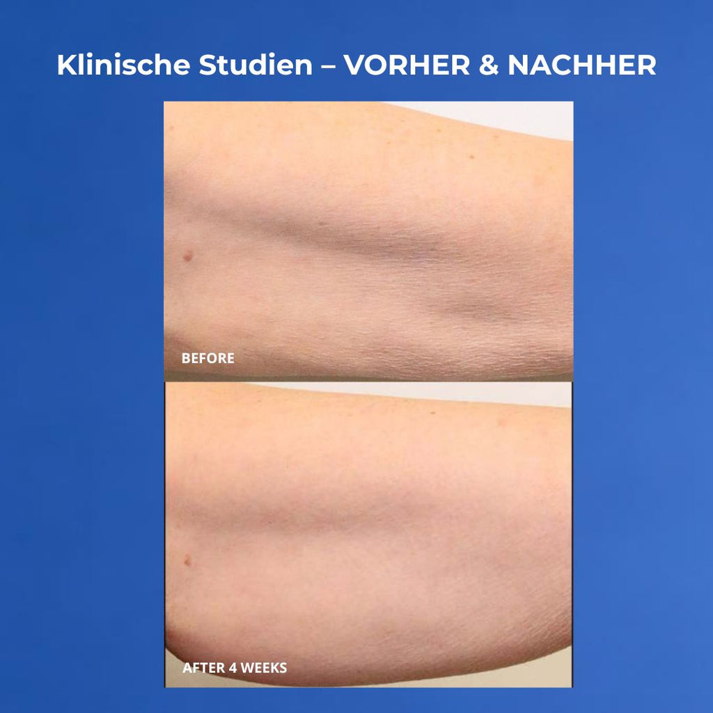 VOL.U.LIFT BODY Vorher nachher Oberarme nach 4 Wochen