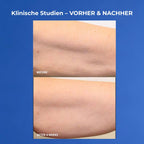 VOL.U.LIFT BODY Vorher nachher Oberarme nach 4 Wochen