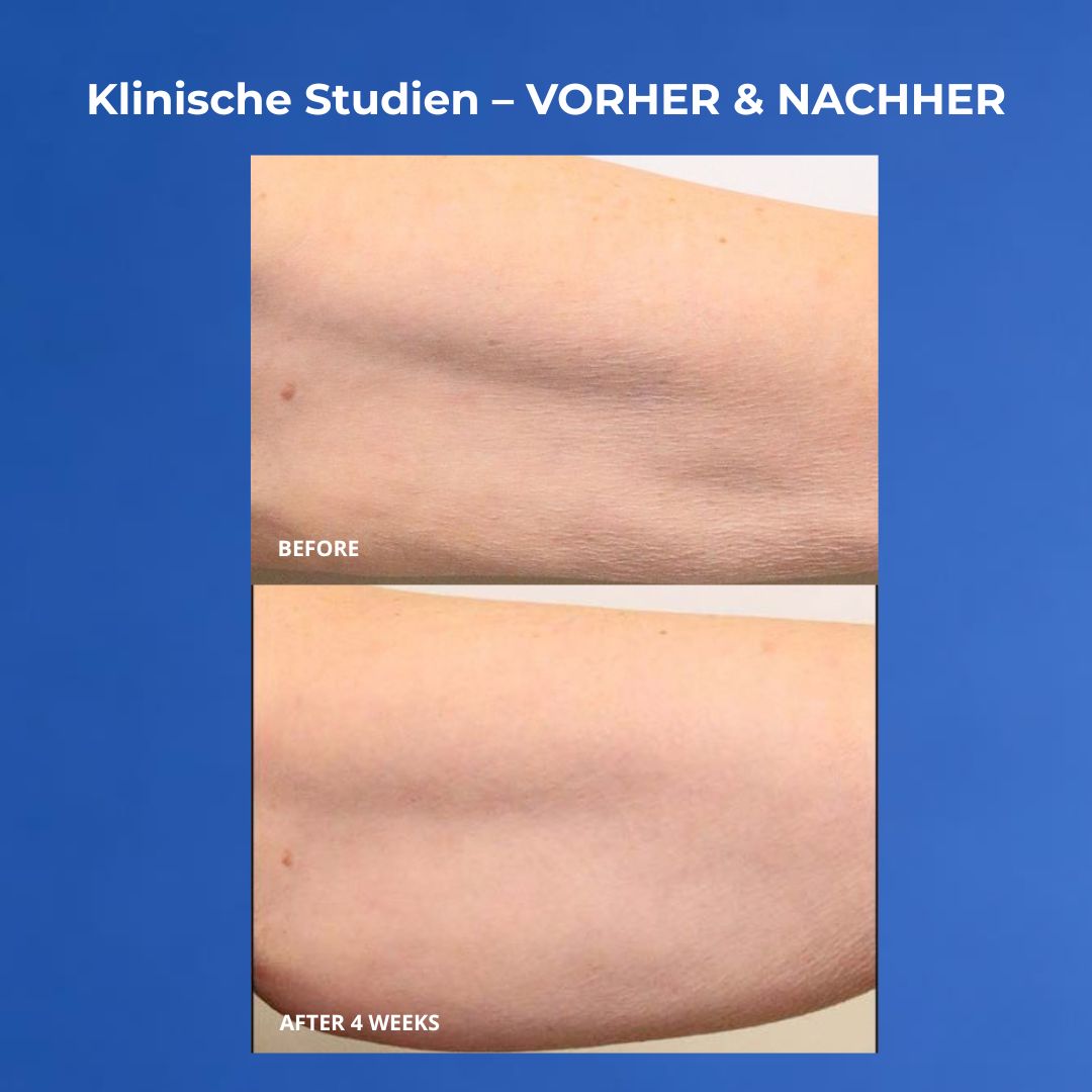 VOL.U.LIFT BODY Vorher nachher Oberarme nach 4 Wochen